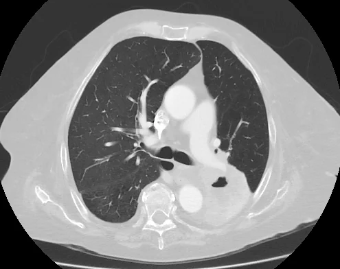 Chest CT slice showing a cavitating tumour in the left lower lobe, circled