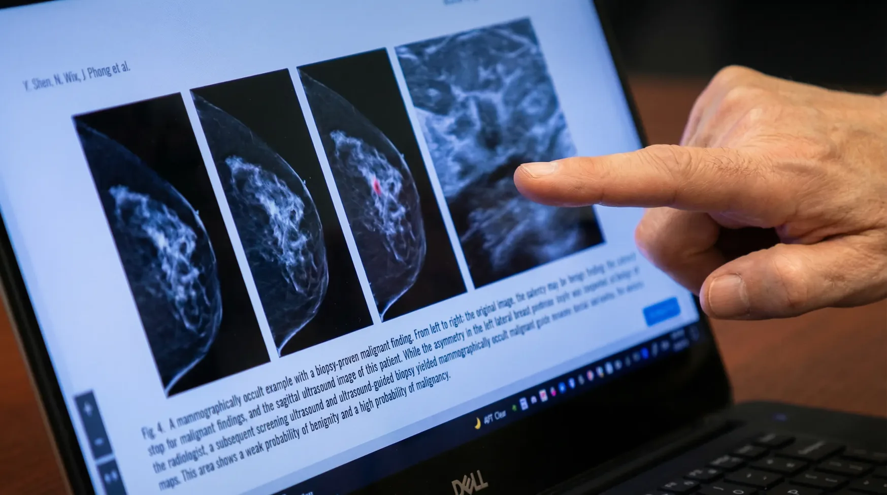 AI mammogram risk analysis process